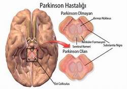 Parkinson hastalığında erken tedavi 