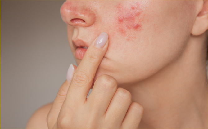 Yüzde Aniden Beliren Kabarıklık Ürtiker ve Anjioödem Habercisi Olabilir!