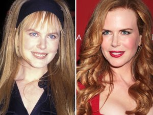 Botoks Ve Dolgu Güzelleri