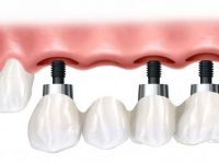 İmplantlara Bakım Uyarısı