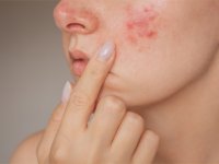 Yüzde Aniden Beliren Kabarıklık Ürtiker ve Anjioödem Habercisi Olabilir!