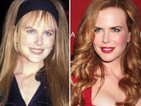 Botoks Ve Dolgu Güzelleri