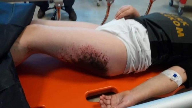 Afyonkarahisar’da Öğrencilerin Vücutlarındaki Yanıkların Sebebi Belli Oldu