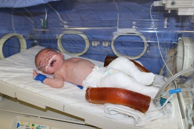 Kuzey Bebeğe Kuvözde Alçı Tedavisi